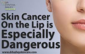 Image result for Lip Cancer