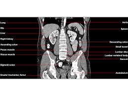 Mri patterns of neuromuscular disease involvement thigh & other muscles 2. Ct Abdomen And Pelvis Coronal Anatomy In The Male Cute766