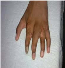 Uncommon congenital anomaly characterized by unilateral imaging findings. A 13 Year Old Boy With Poland Syndrome Having Asymmetrical Chest Wall Download Scientific Diagram