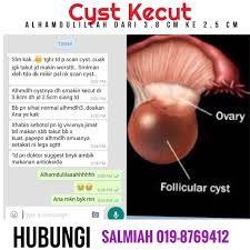 Kos cyst ovari endometrioid bergantung kepada kerumitan penyakit. Kenali Tanda Tanda Cyst Dan Cara Atasinya Tanpa Perlukan Pembedahan