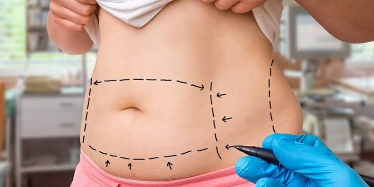 SculpSure Body Contouring In Riyadh & Saudi Arabia