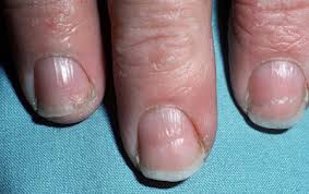 Image result for Muehrcke Line