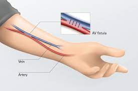 • the brachiocephalic fistula at the elbow utilizes the upper arm segment of the cephalic vein and generally is the second choice site for arteriovenous fistula creation. New Procedure Creates Dialysis Fistula Without Surgery Ria Endovascular