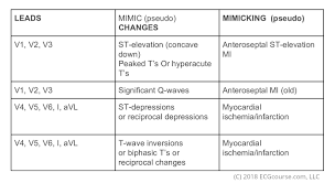 Acute Inferior Stemi Dr Stanleys Ecgcourse Com