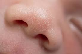 Deficiencies in calcium, vitamin d and vitamin e can cause white patches on the skin. White Spots On A Child S Face Causes Remedies Treatment
