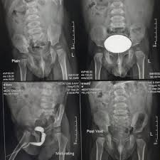 Image result for Voiding Cystourethrogram