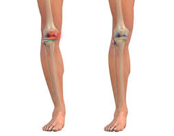 Exercises For Knock Knees Knock Knees Is A Term Used To Describe An Inward Angle Of The Thighs Whevia Affimity Bow Legged Bow Legged Correction Knock Knees