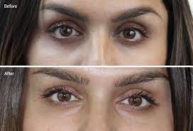 Laser Treatments For Dark Circles Are They Worth It Before Afters Cost