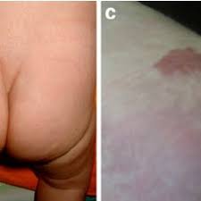 The Management Of Four Hypothetical Cases With Different Skin Stigmata Download Scientific Diagram