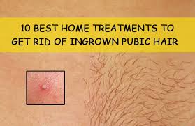 This cream will unclog the hair follicle by removing any dead skin cells, causing the hair to be less tightly bedded within it. 10 Effective Home Remedies To Get Rid Of Ingrown Pubic Hair Soon
