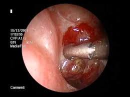 The nasal cavity warms and moistens the air we breathe and helps to filter out small particles and harmful bacteria. Nose Cancer Nasopharyngeal Carcinoma Recurrence And Biopsy Www Drjeeve Com Youtube