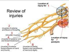 Brachial Plexus Therapy Activities Brachial Medical Information