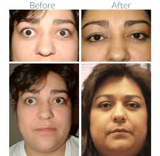 Graves Disease Treatments In Denver Thyroid Disease In Boulder Co
