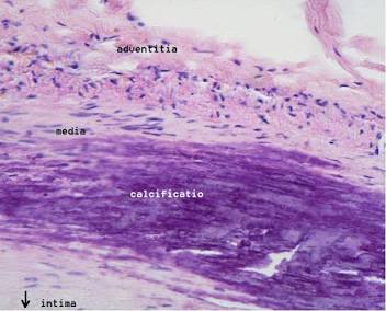 Histological cross-section showcasing dense basophilic calcification within the tunica media layer., AI generated