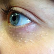 As milia often go away on their own without any treatment, being patient and waiting it out is the better option but waiting is definitely not for all. Milia The Whitehead That Won T Go Away Beauty Mark Boutique