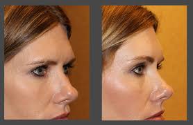 View before & after photo gallery. Brow Lift In Austin Forehead Lift Dr Malena Amato