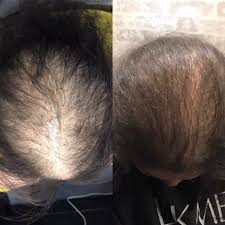 If you've been experiencing hair loss, you may be considering your treatment options. Microchanneling Healthy Skin New Hair Follicles