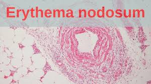 Image result for erythema nodosum