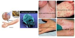 Makalah studi … kudis buta scabies dan artikel terkait dengan topik patofisiologi penyakit kudis buta scabies. Anak Dan Scabies Aka Kudis Buta Nurralif