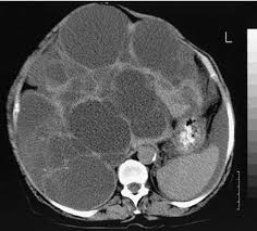 De factoren die een cyste kunnen veroorzaken en. Wat Is Het Beleid Als Bij Toeval Op Een Echo Multipele Kleine Cystes In De Lever Worden Gezien Springerlink