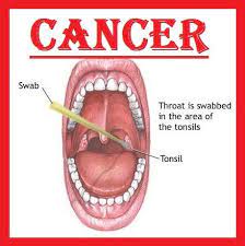 Oral cancer can affect the mouth including the gums, lips, tongue, mouth's roof, and floor and the inner cheeks. Throat Cancer Introduction Types Symptoms Treatment