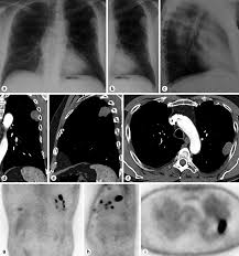Papillary mesothelioma is a rare subtype of epithelial mesothelioma characterized by its slow growth and its limited ability to spread throughout the body. Https Www Karger Com Article Pdf 512013