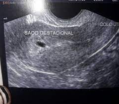 Beta Hcg Nao Evolui Como Deveria Gravidez Assuntos Gerais Babycenter