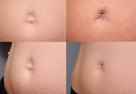 Get a dazzling smile, knock a few inches off your waist line and kiss plucking and shaving goodbye! Belly Button Surgery Is A Trend And It S On The Rise Shafer David Shaferplasticsurgery Com