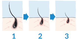 You probably know by now that testosterone is the hormone that is converted to a more potent form inside the body called dihydrotestosterone (dht). Does Smoking Cause Hair Loss