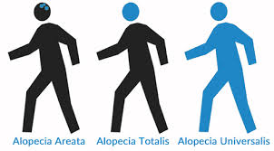 It can strike children and adults randomly, even those in good health. Topical Alopecia Totalis And Universalis Jak Inhibitor Treatment Trial