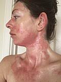 Image result for Rhus Dermatitis