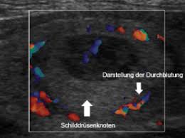 Ven prädiktiven wert 21 (abb. Schilddrusen Untersuchungen Zrn Info De