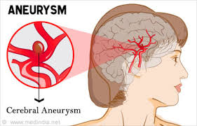 Aneurysm Types Causes Symptoms Diagnosis Treatment Prevention A brain aneurysm is an area of weakness in a brain blood vessel that over time can grow larger brain aneurysms that are discovered before they have bled are often treated to prevent rupture.