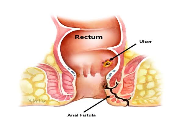 Anal Fistula Laser Treatment