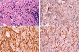 Mesothelioma is an increasingly frequent malignancy in which diagnosis is often delayed and disease diagnosed at an advanced stage. Simultaneous Occurrence Of Bilateral Malignant Pleural Mesothelioma Springerlink
