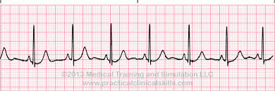 Ekg P Wave Practice Drill Ekg Ekg Strips Nursing Tips