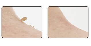Fibrom