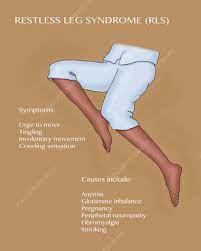 Restless Leg Syndrome Illustration Stock Image C036 6302 Science Photo Library