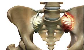 Image result for Sacroiliac Dysfunction