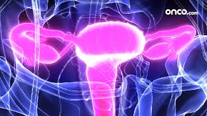 Side Effects Of Radiation Therapy For Ovarian Cancer Onco Com