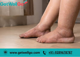 Image result for Edema