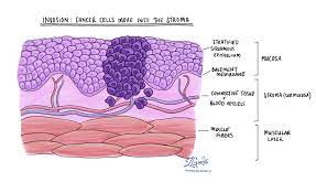 Squamous cell carcinoma is a cancer of the skin that generally appears as a thin, flat cell on the outer layer of the skin. Squamous Cell Carcinoma Of The Larynx Mypathologyreport Ca