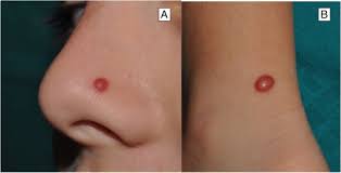 Image result for Spitz Nevus
