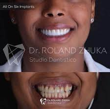 Corona in Zirconia & E-Max Albania