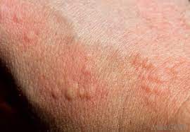 What Are The Symptoms Of A Tomato Allergy With Pictures