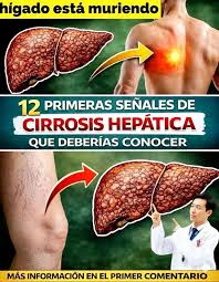 🚨🫀 ¿Está tu hígado en peligro? 12 señales de cirrosis hepática que NO  deberías ignorar 😮‍💨 Cansancio extremo, hinchazón, cambios en la piel,  problemas digestivos… muchas personas confunden estas señales y actúan