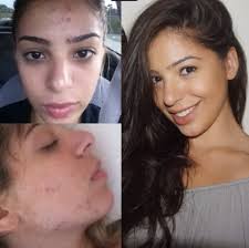 How I Cleared My Acne (Cystic, Hormonal & Digestive Causes)