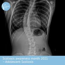 How long does scoliosis surgery take. Scoliosis Archives Scoliosis Clinic Uk Treating Scoliosis Without Surgery