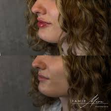 Summer-ready lips 💋 💉 Schedule your lip filler appointment with Jamie Mora,  PA-C @Studiophilly Instagram: link in bio 📱 267-586-4978 Hablo Español  🇨🇴 Pricing: Lip Filler: $600 full, $400 half Cheek or