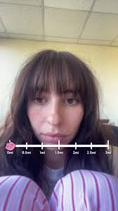 what in the anaphylaxis